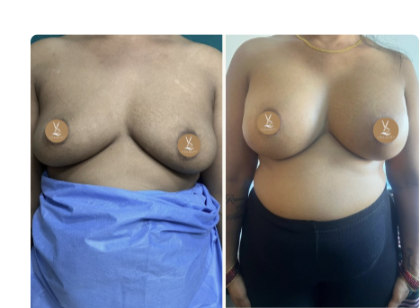 Front View · Patient 1 before and after