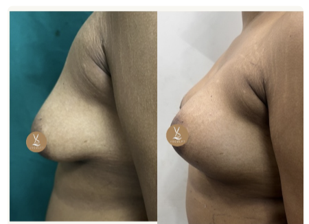 Side Profile · Patient 4 before and after